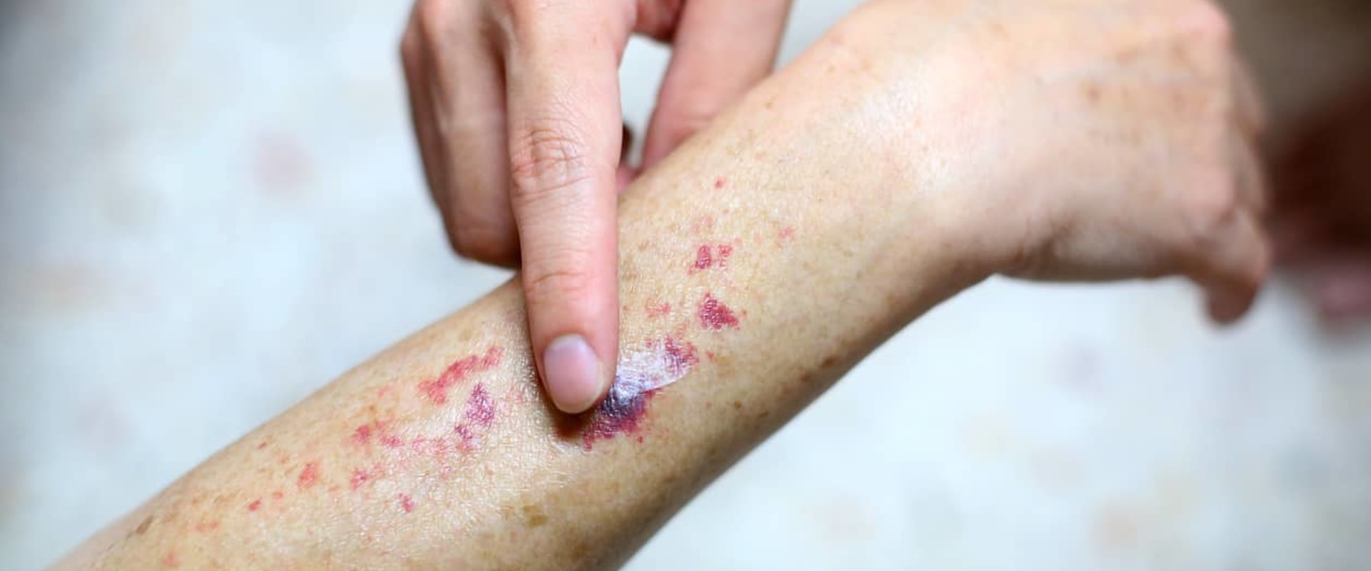 Uncovering Purpura Simplex Rashes and Bruises Without Serious Risk