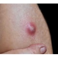 Boil vs Cyst vs Abscess: Signs, Risks & Safe Treatments
