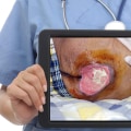 Granulation Tissue Pictures: Understanding Wound Healing Stages, Signs of Infection, and When to Seek Medical Help