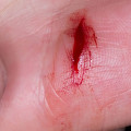 person smelling the wound that signs of healing