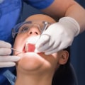 How Long Do Dissolvable Stitches Last and What to Expect as They Heal