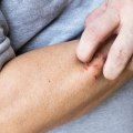 Is Itching a Sign of Healing? Know the Facts About Why Your Skin Itches and What It Means for Healing