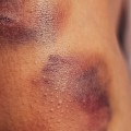 Does a Blood Clot Look Like a Bruise on Your Skin? DVT Symptoms, Risks & Prevention