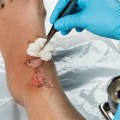 The Vital Role of Certified Wound Care Nurses