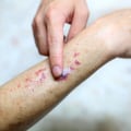 Uncovering Purpura Simplex Rashes and Bruises Without Serious Risk