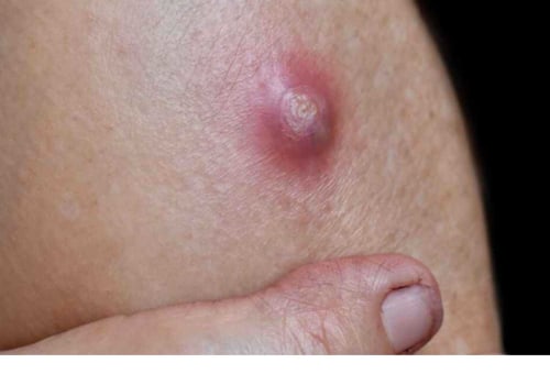 Boil vs Cyst vs Abscess: Signs, Risks & Safe Treatments