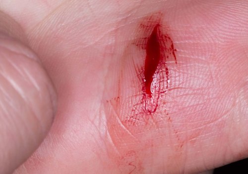 What Does a Healing Wound Smell Like? Normal Odors vs Infection Signs