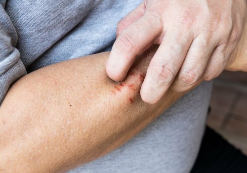 Is Itching a Sign of Healing? Know the Facts About Why Your Skin Itches and What It Means for Healing