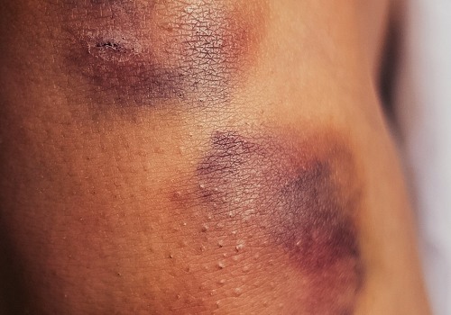 Does a Blood Clot Look Like a Bruise on Your Skin? DVT Symptoms, Risks & Prevention