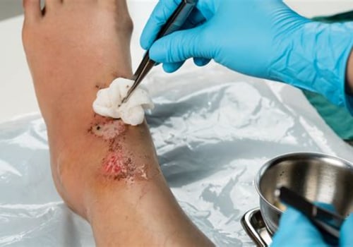 The Vital Role of Certified Wound Care Nurses
