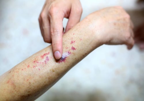 Uncovering Purpura Simplex Rashes and Bruises Without Serious Risk